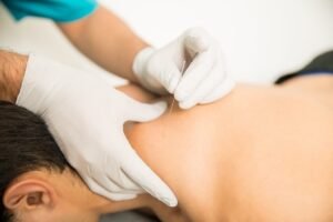 dry-needling